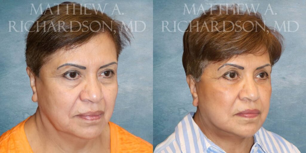 Facelift Before and After photo by Texas Facial Aesthetics in Francisco TX