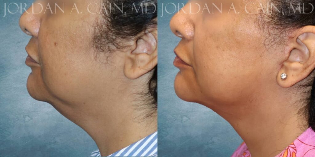 Facelift Before and After photo by Texas Facial Aesthetics in Francisco TX