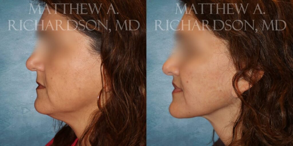 Facelift Before and After photo by Texas Facial Aesthetics in Francisco TX