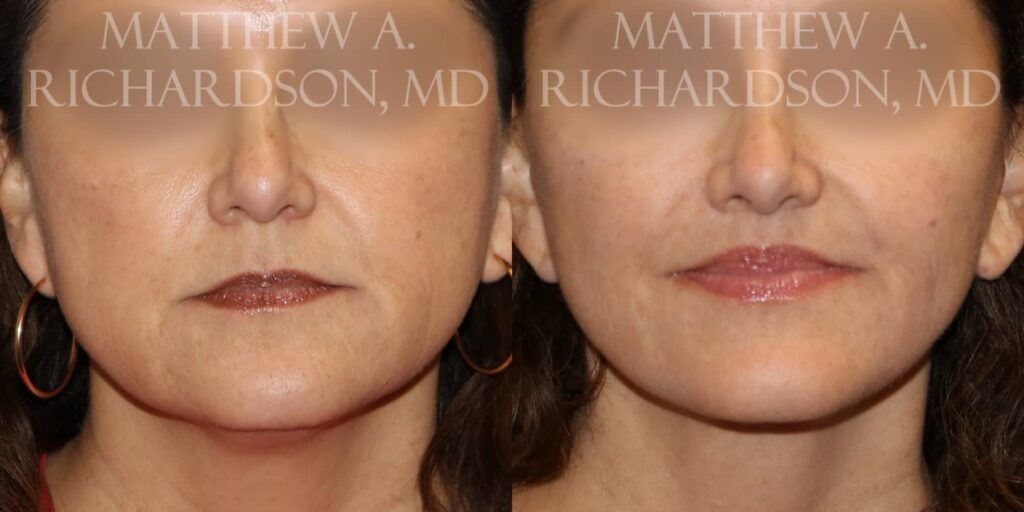 Lip Lift Before and After photo by Texas Facial Aesthetics in Francisco TX