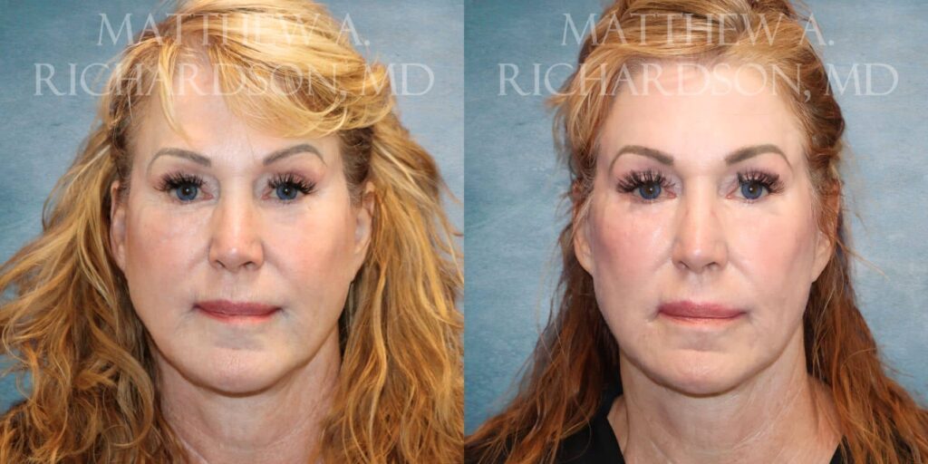 Chemical Peel Before and After photo by Texas Facial Aesthetics in Francisco TX