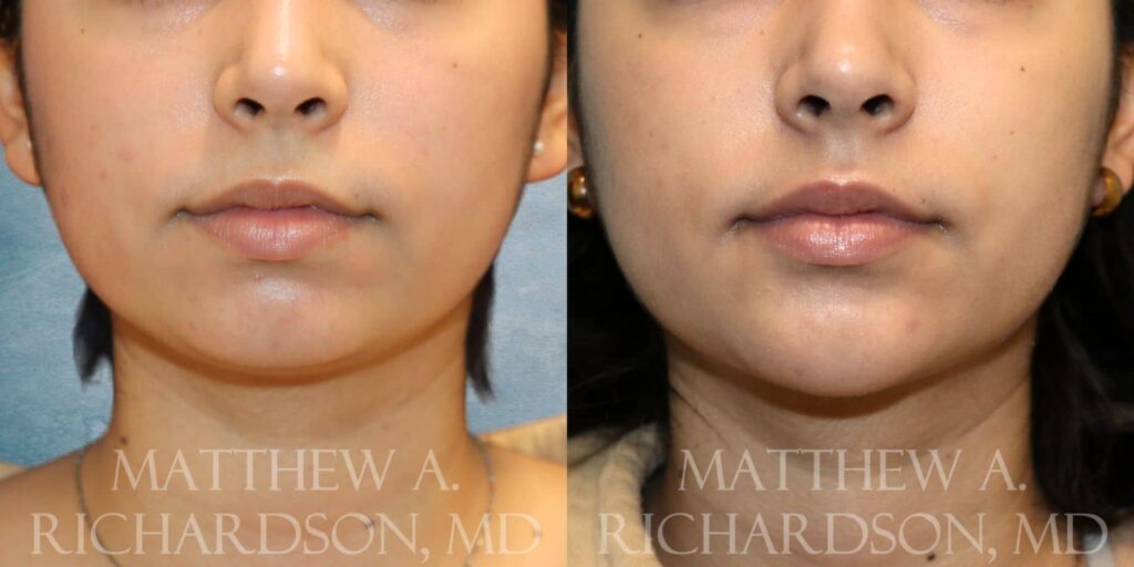 Kybella Before and After photo by Texas Facial Aesthetics in Francisco TX