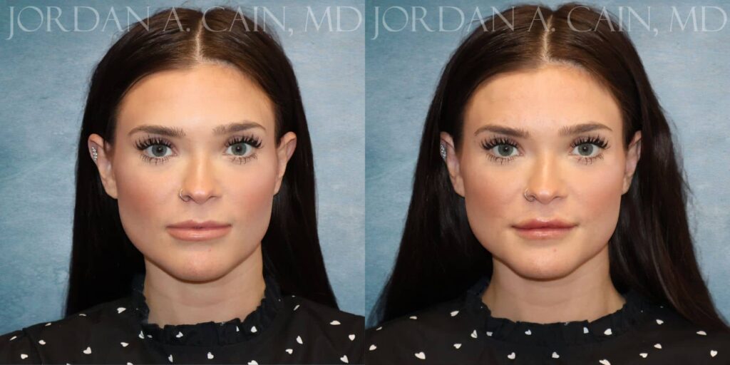 Lip Filler Before and After photo by Texas Facial Aesthetics in Francisco TX