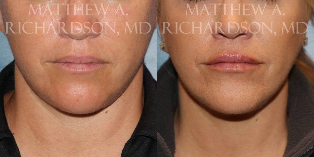 Lip Filler Before and After photo by Texas Facial Aesthetics in Francisco TX