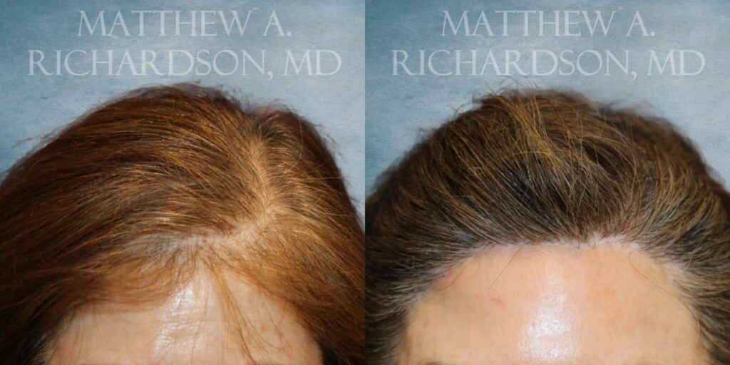 Hair Transplant Before and After photo by Texas Facial Aesthetics in Francisco TX