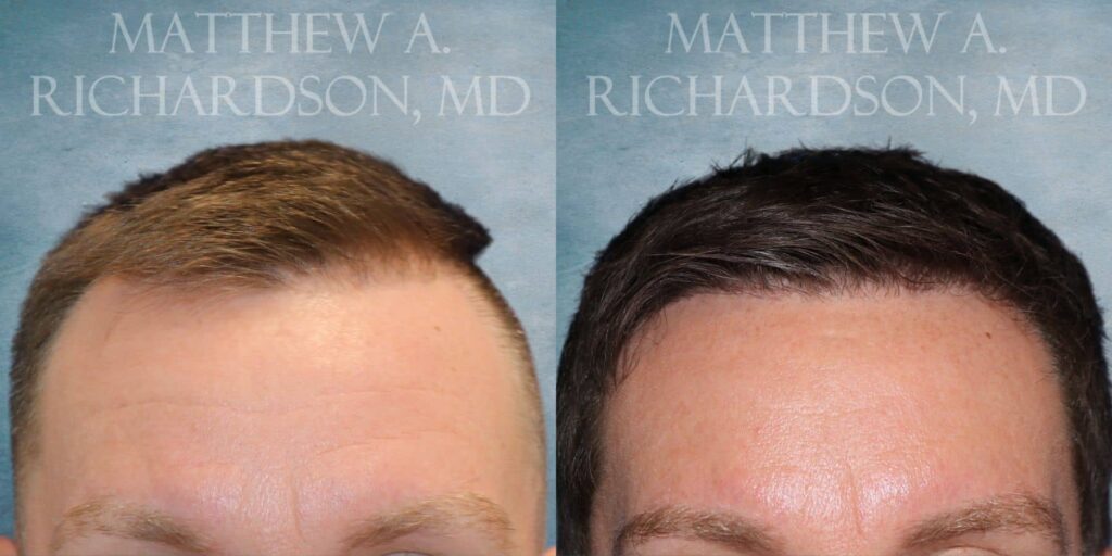 Hair Transplant Before and After photo by Texas Facial Aesthetics in Francisco TX