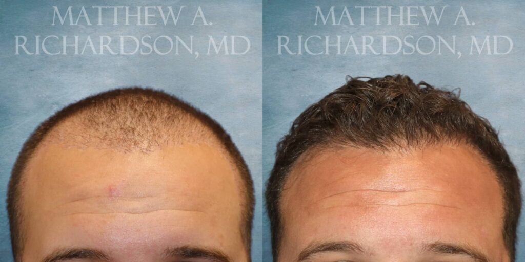 Hair Transplant Before and After photo by Texas Facial Aesthetics in Francisco TX