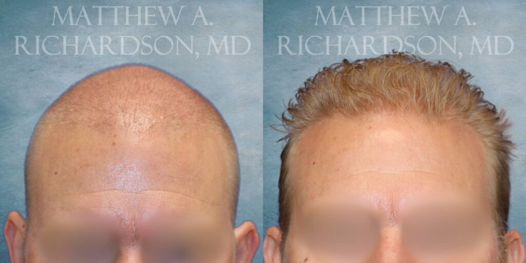 Hair Transplant Before and After photo by Texas Facial Aesthetics in Francisco TX