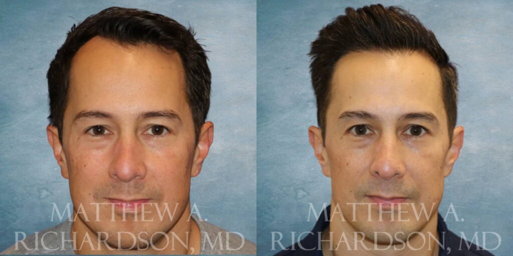 Hair Transplant Before and After photo by Texas Facial Aesthetics in Francisco TX