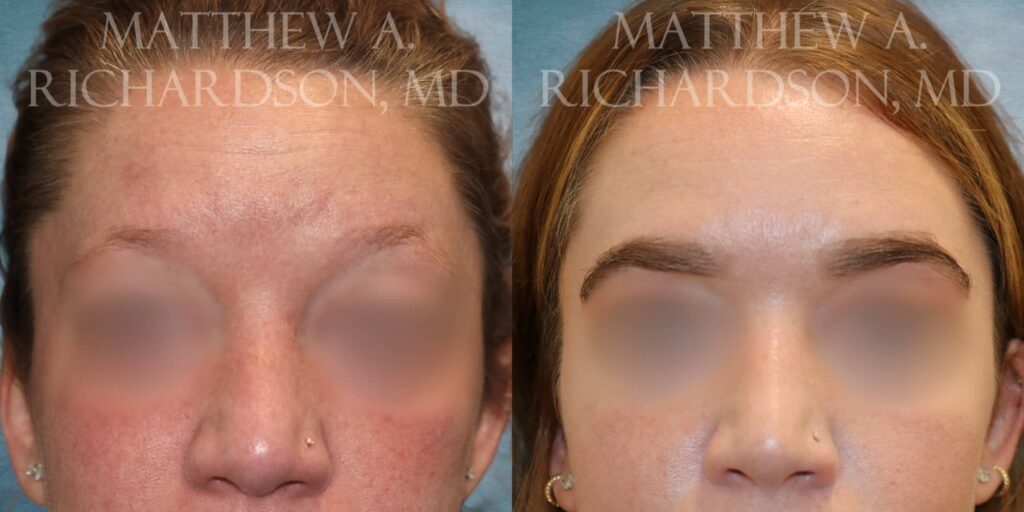 Eyebrow Transplant Before and After photo by Texas Facial Aesthetics in Francisco TX