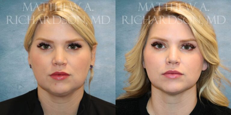 Facetite Before and After photo by Texas Facial Aesthetics in Francisco TX
