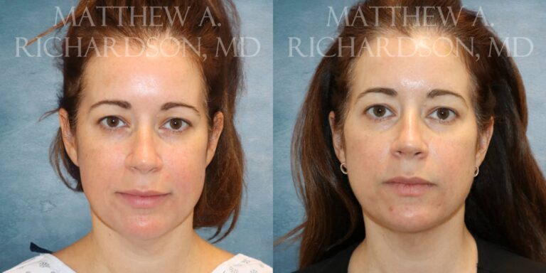 Facetite Before and After photo by Texas Facial Aesthetics in Francisco TX