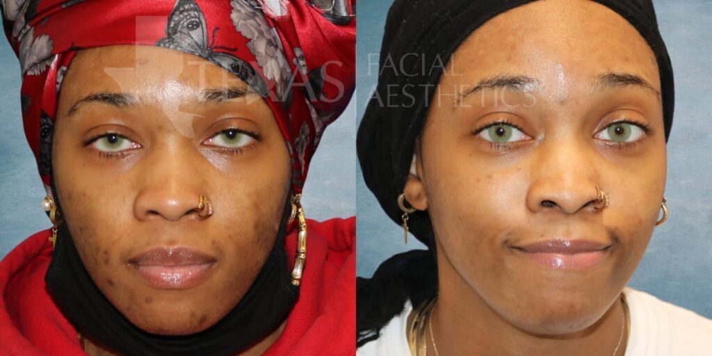 VI Peel Before and After photo by Texas Facial Aesthetics in Francisco TX