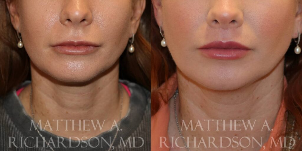 Lip Lift Before and After photo by Texas Facial Aesthetics in Francisco TX