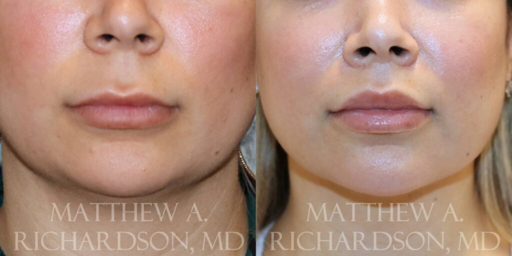 Lip Lift Before and After photo by Texas Facial Aesthetics in Francisco TX