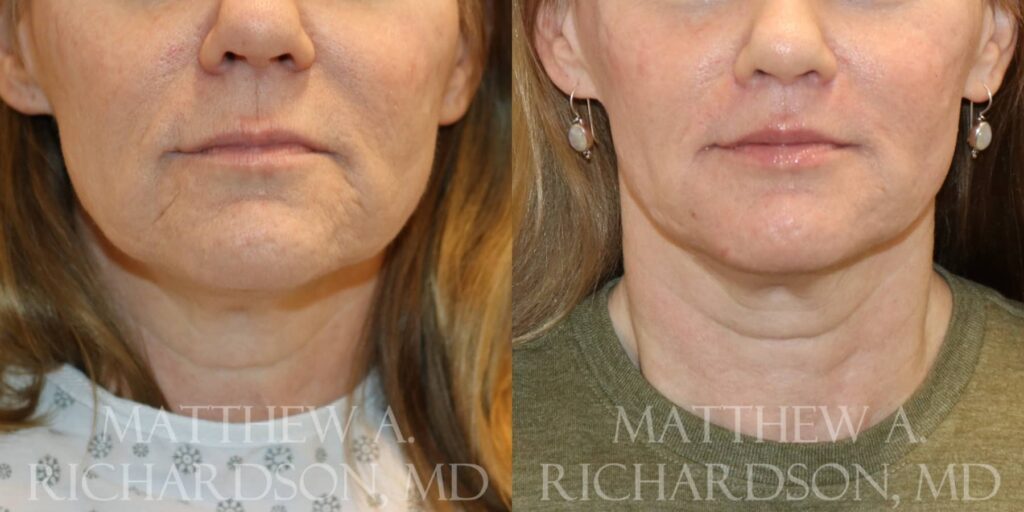 Lip Lift Before and After photo by Texas Facial Aesthetics in Francisco TX