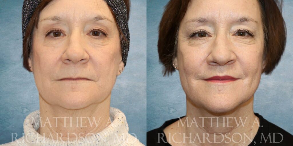 Lip Lift Before and After photo by Texas Facial Aesthetics in Francisco TX