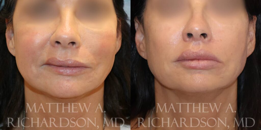 Lip Lift Before and After photo by Texas Facial Aesthetics in Francisco TX