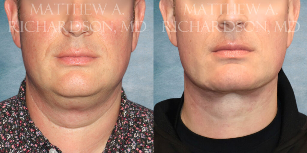 Neck Lift Before and After photo by Texas Facial Aesthetics in Frisco TX