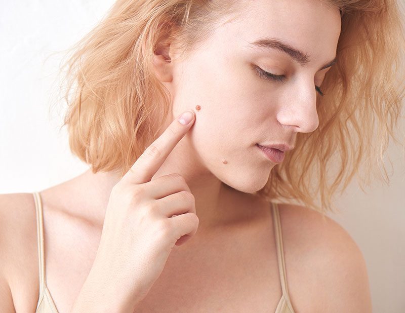 A woman points to a mole on her face.