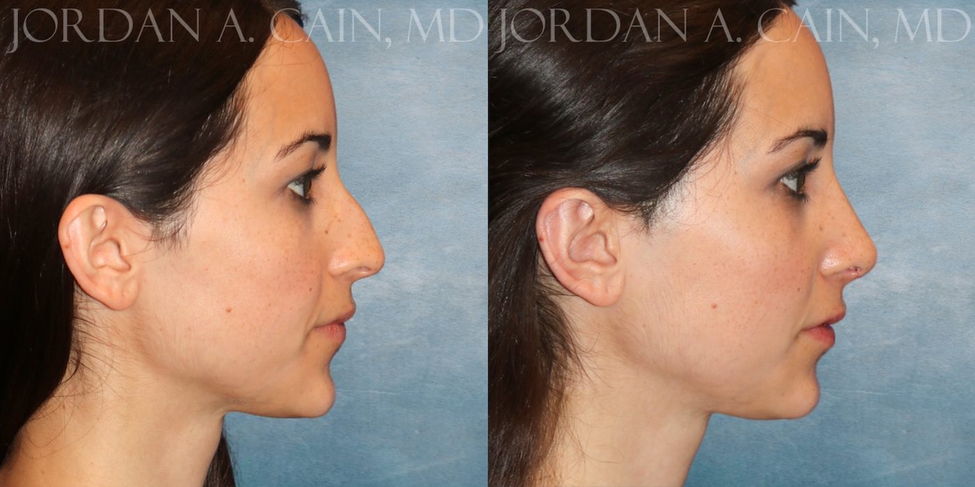 Rhinoplasty Website