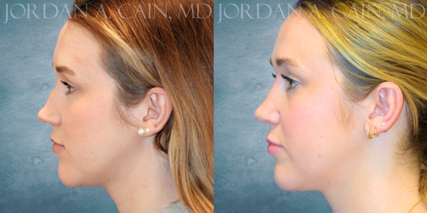 Rhinoplasty Website