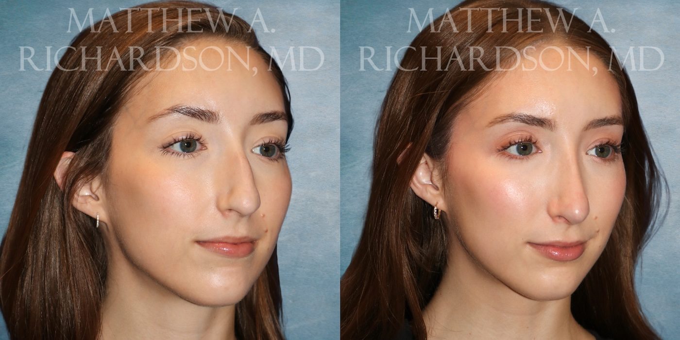 Rhinoplasty Website