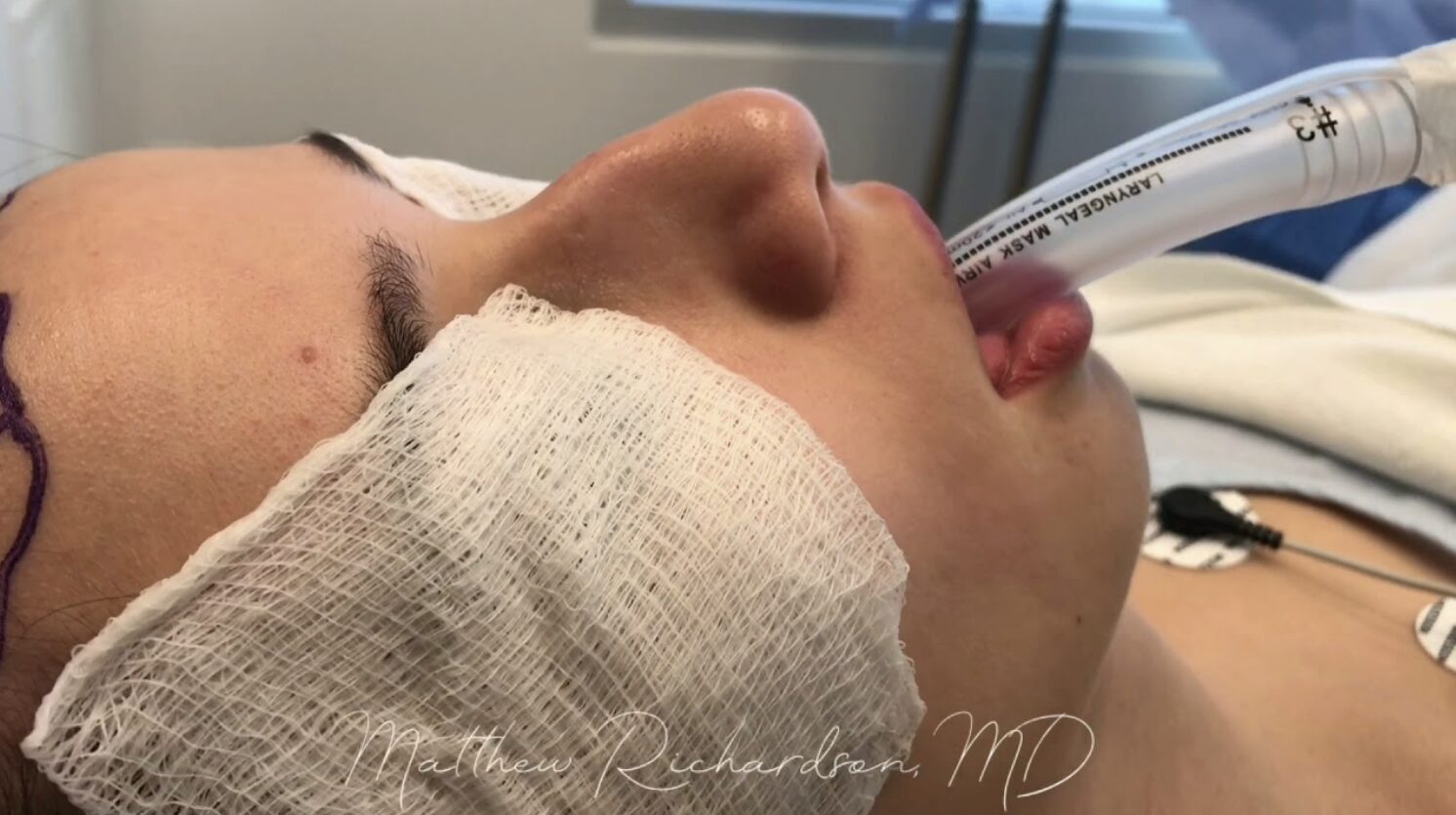 rhinoplasty video thumbnail