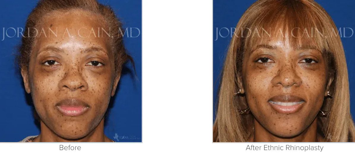 Ethnic Rhinoplasty Before and After Photo Performed by Matthew A. Richardson MD