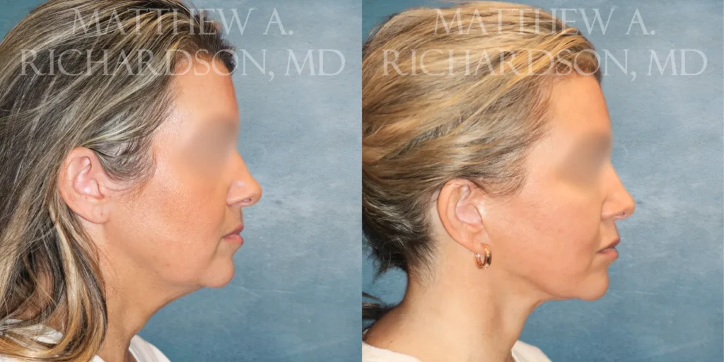 Mini Lift Before and After photo by Texas Facial Aesthetics in Francisco TX