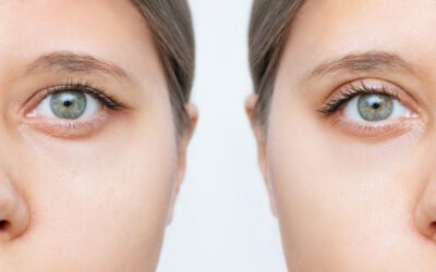 How Blepharoplasty Can Rejuvenate Your Eyes: What to Expect and Why It’s Growing in Popularity