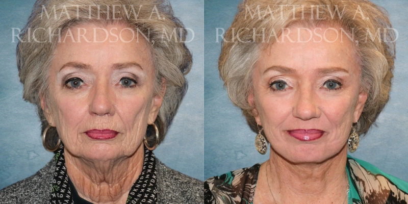 before and after facelift at tx facial aesthetics before and after facelift at tx facial aesthetics