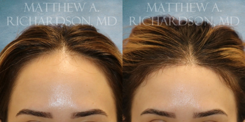 before and after hairline lowering at texas facial aesthetics before and after hairline lowering at texas facial aesthetics