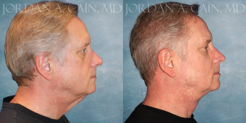before and after facelift at tx facial aesthetics before and after facelift at tx facial aesthetics