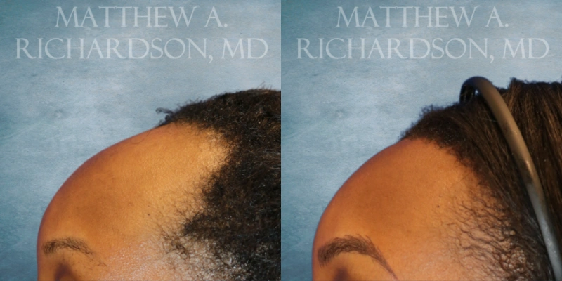 before and after hairline lowering at texas facial aesthetics before and after hairline lowering at texas facial aesthetics
