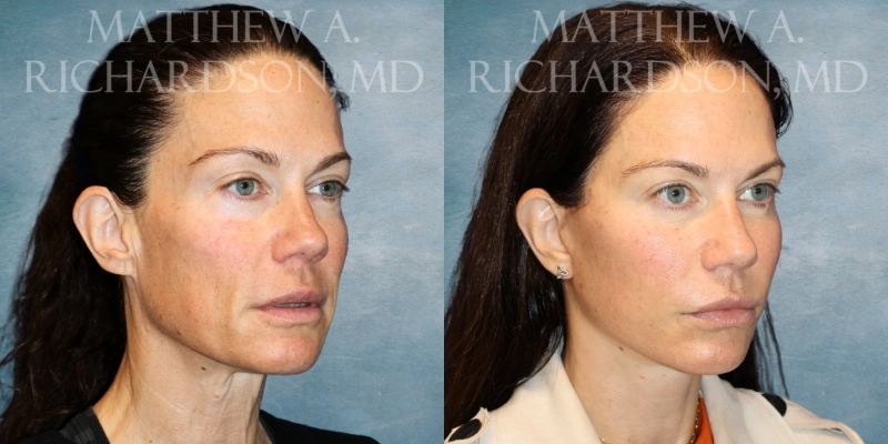 before and after facelift at tx facial aesthetics before and after facelift at tx facial aesthetics