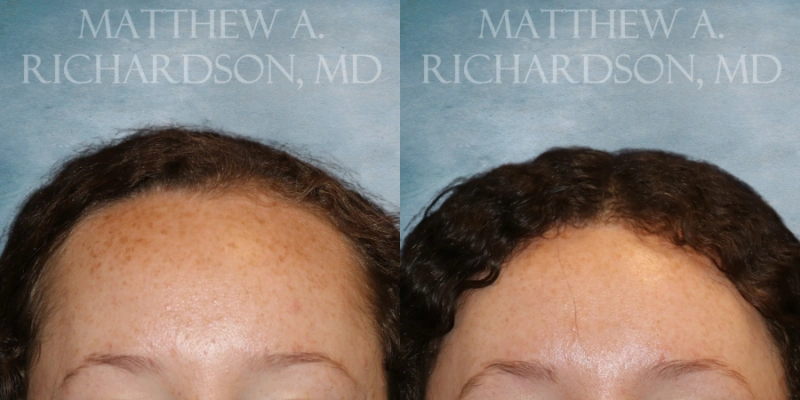 before and after hairline lowering at texas facial aesthetics before and after hairline lowering at texas facial aesthetics