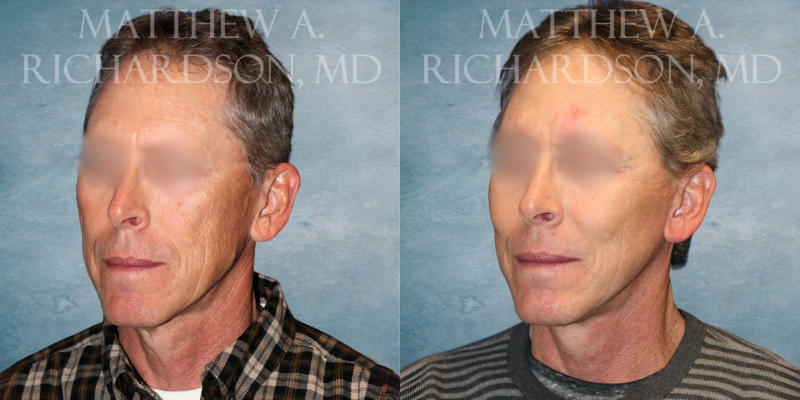 before and after facelift at tx facial aesthetics before and after facelift at tx facial aesthetics