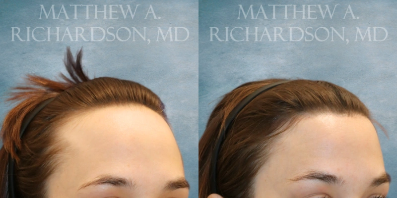 before and after hairline lowering at texas facial aesthetics before and after hairline lowering at texas facial aesthetics