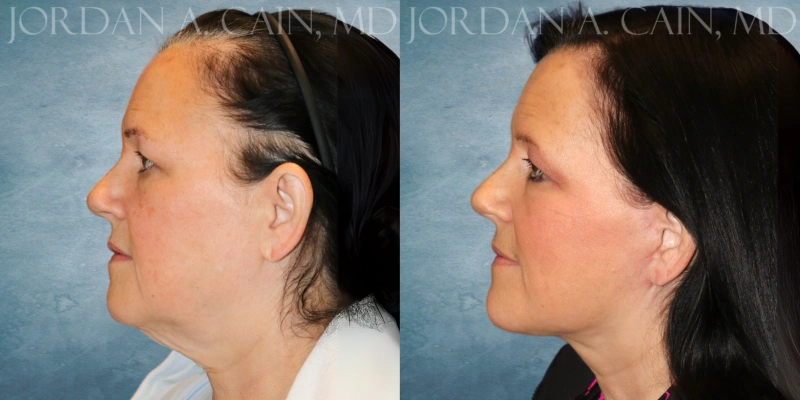 before and after facelift at tx facial aesthetics before and after facelift at tx facial aesthetics