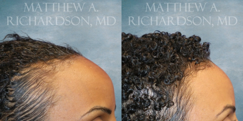 before and after hairline lowering at texas facial aesthetics before and after hairline lowering at texas facial aesthetics