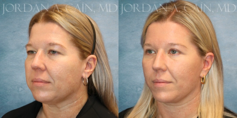 before and after facelift at tx facial aesthetics before and after facelift at tx facial aesthetics