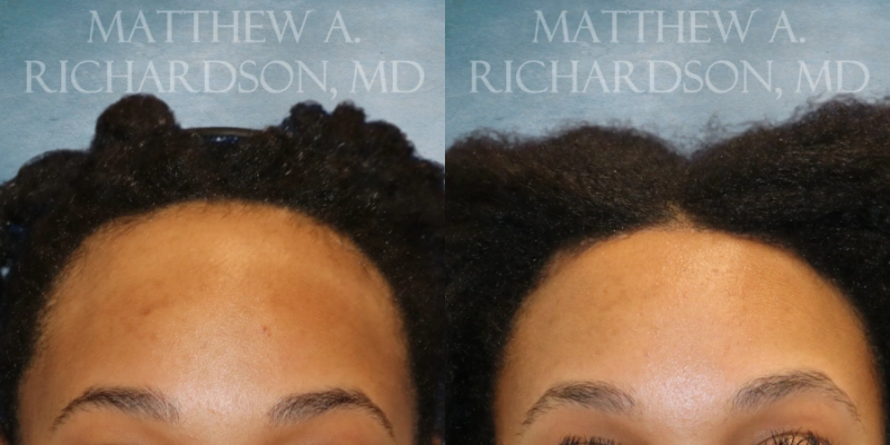 before and after hairline lowering at texas facial aesthetics before and after hairline lowering at texas facial aesthetics