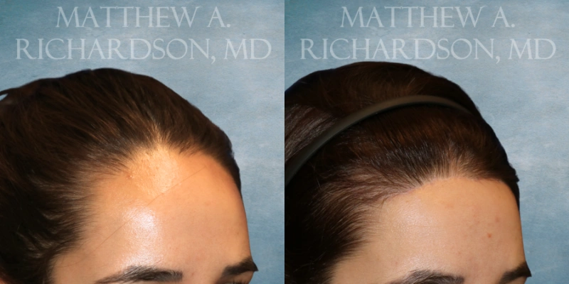before and after hairline lowering at texas facial aesthetics before and after hairline lowering at texas facial aesthetics