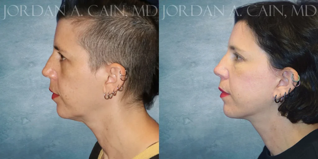 Facelift Before and After photo by Texas Facial Aesthetics in Francisco TX