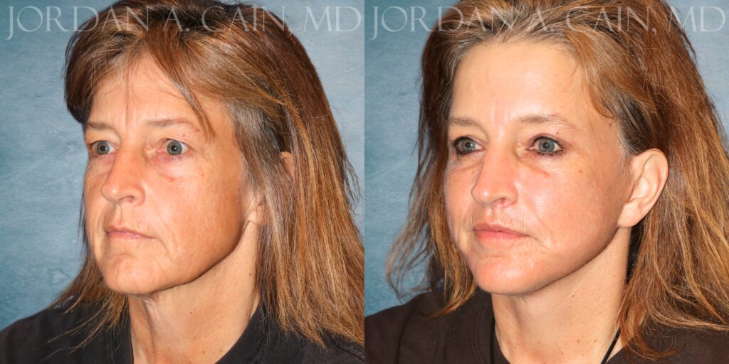 Left Oblique Month PO