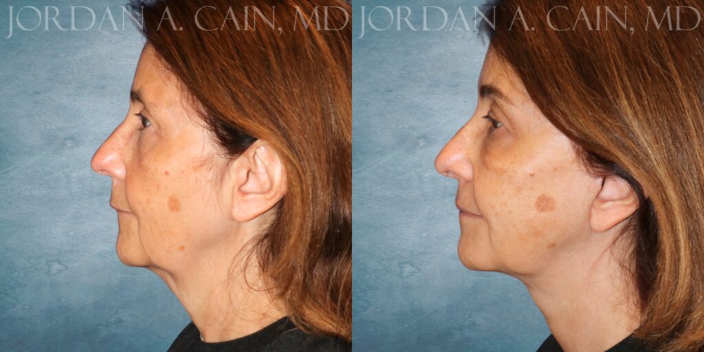 Left Profile Month PO