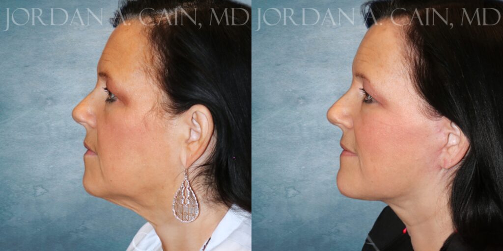 Left Profile Month PO