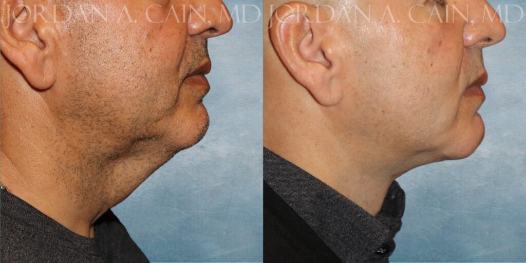 Right Profile Month PO