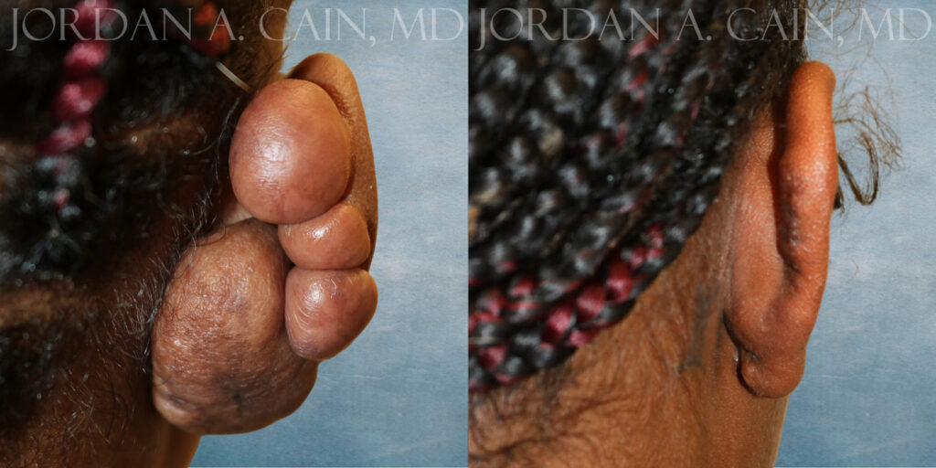 Back View Keloid Removal by Dr Cain